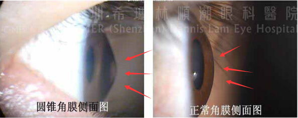 圓錐角膜患者角膜會慢慢變薄并向外凸出，導致近視或散光度數變化、嚴重時可能引起角膜水腫，影響視力