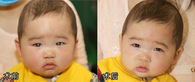 小兒白內障患兒——小洛陽術前及術后天
